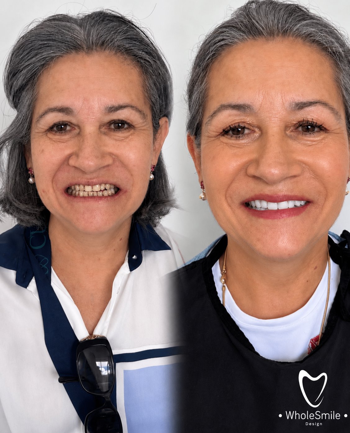 Resultado real de una paciente: antes y después