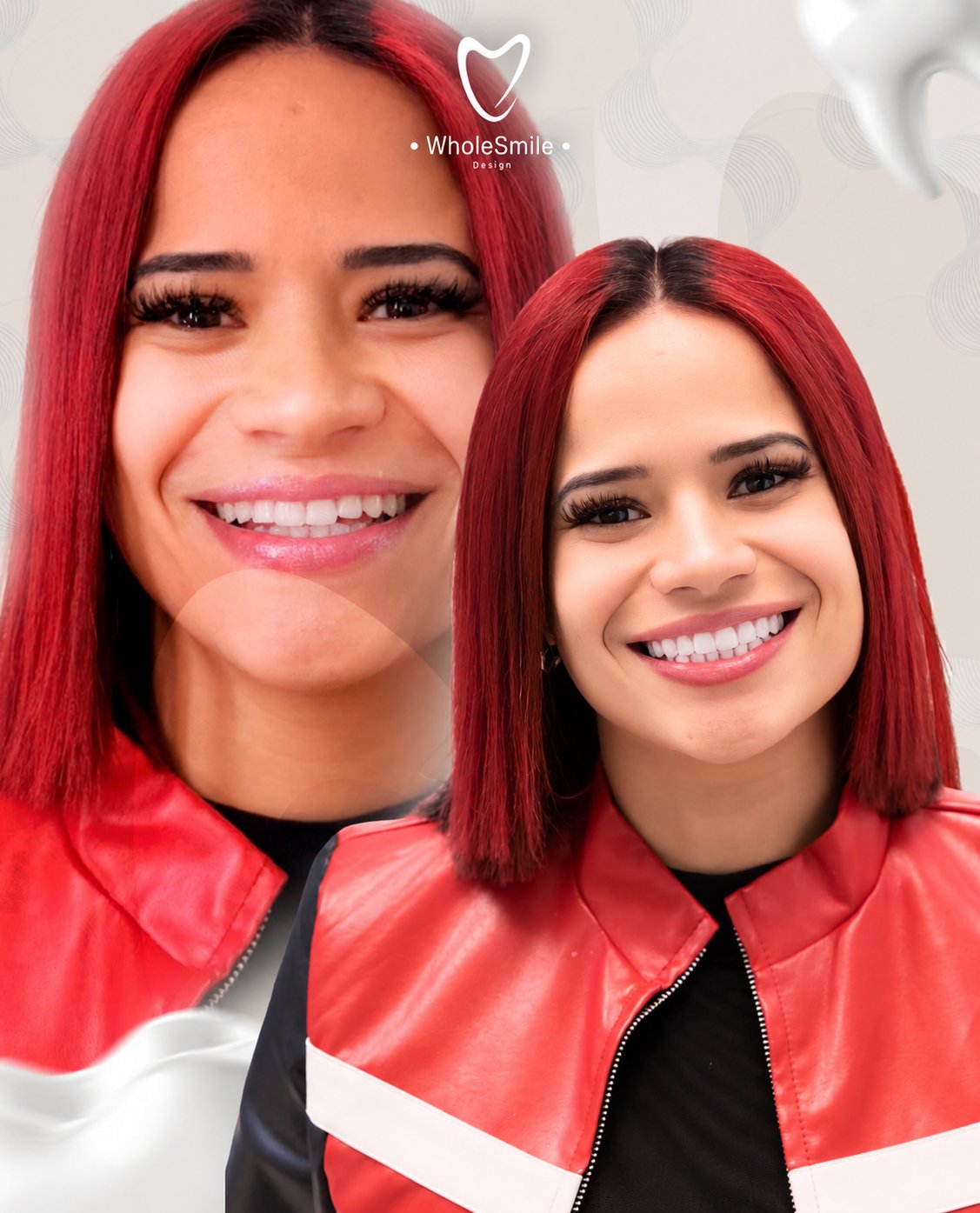 Resultado real de una paciente de Whole Smile Design